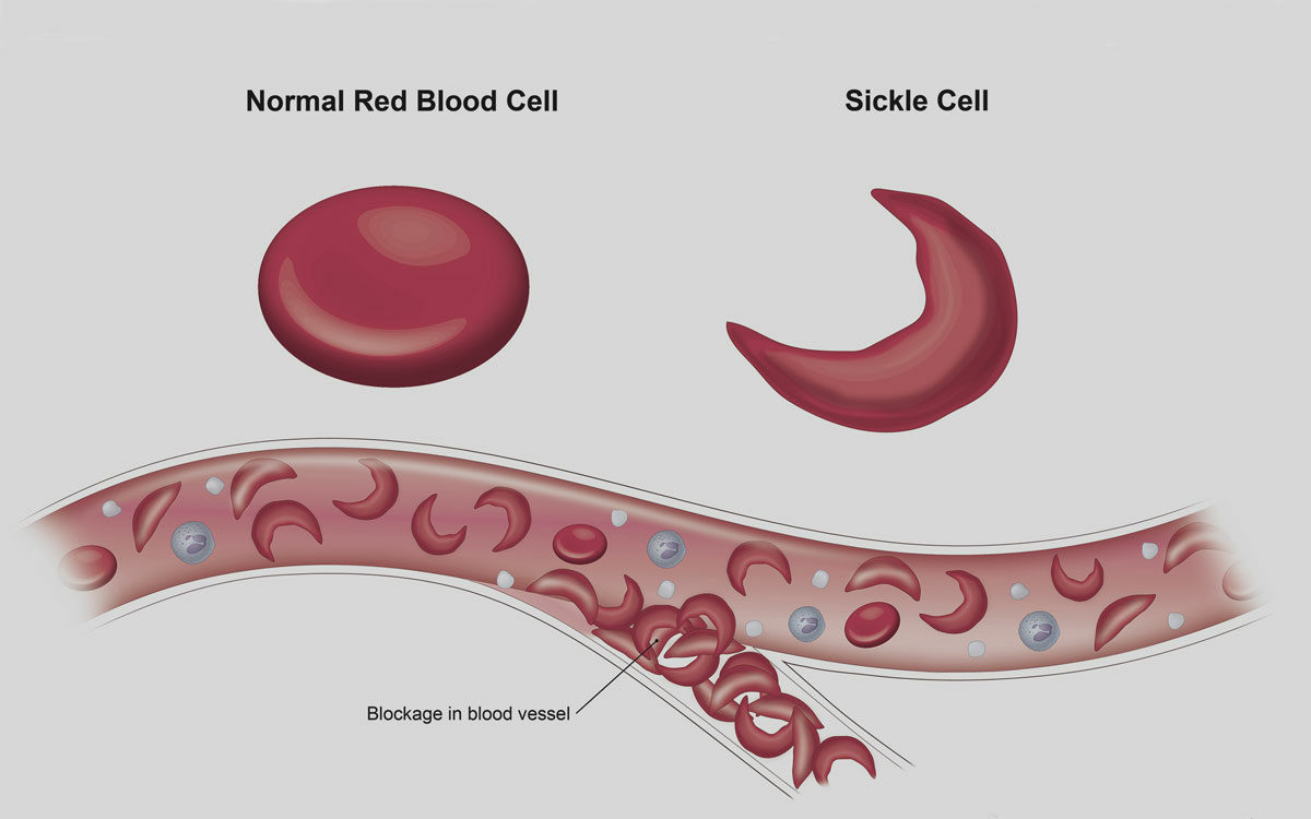 CRISPR gene therapy 'Exa-cel' shows promise for Sickle Cell, FDA nears approval | Credits: Google