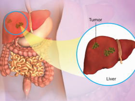 Liver Cancer concerns rise in Mexican-American men: Study | Credits: Focus Medica