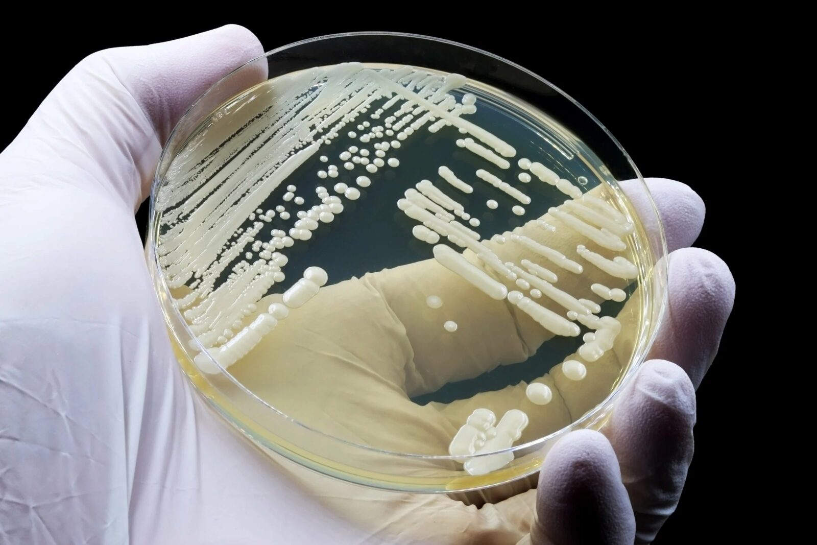 First-ever Candida Auris outbreak hits Washington | Credits: Google Images