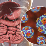 Visual Representation for Hepatitis A infection | Credits: Getty Images