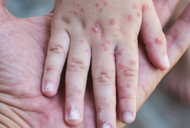 Representation for rash caused due to measles | Credits: Shutterstock